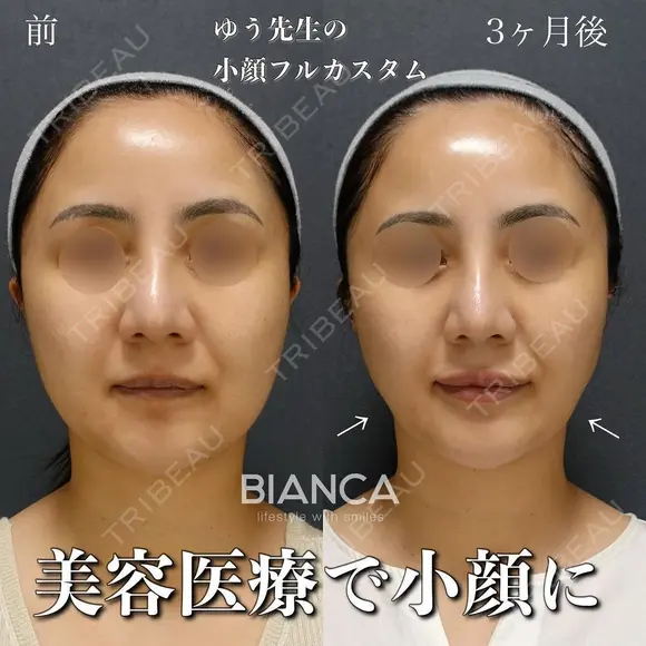 理想の輪郭を手に入れよう💓顔の脂肪吸引＋糸リフト before画像 メイン用