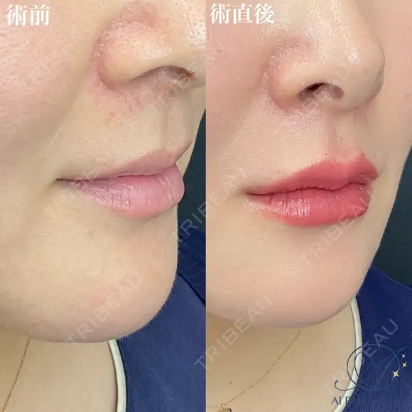 唇ヒアルロン酸 before画像 メイン用