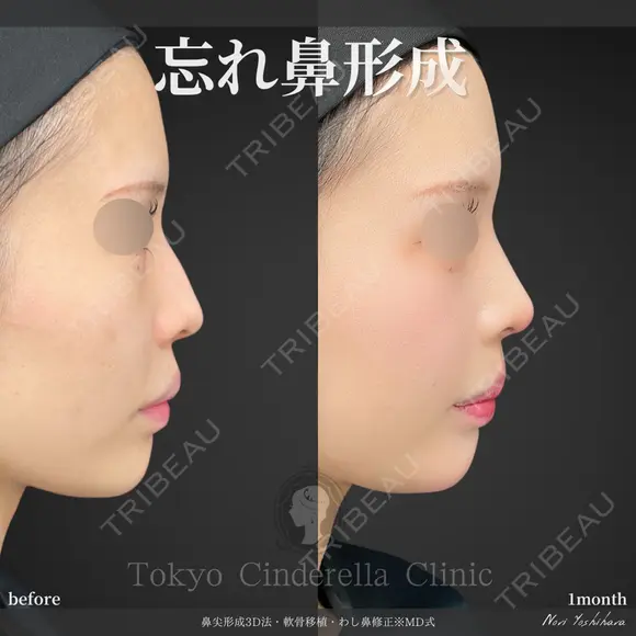 鼻尖形成3D法＋軟骨移植＋わし鼻修正※MD式 30日後 メイン用