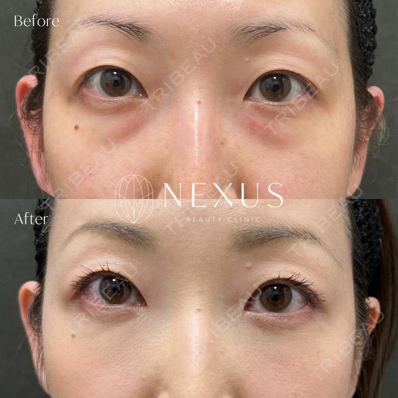切らない目の下のたるみ取り＋脂肪注入 after画像 メイン用