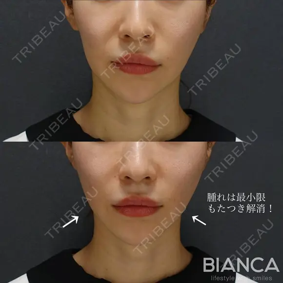 あなたに合ったデザインに😄✨ビアンカ糸リフト after画像 メイン用