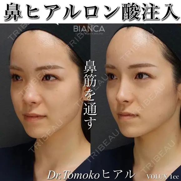 ナチュラルで美しい鼻筋🌷ヒアルロン酸注入💉 before画像 メイン用