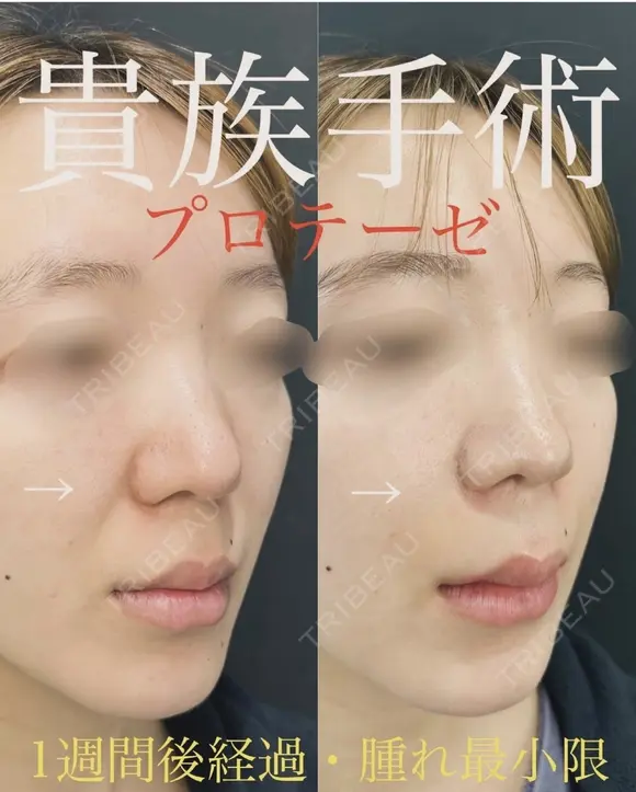 口腔内切開人中短縮×貴族手術×猫手術 before画像 メイン用