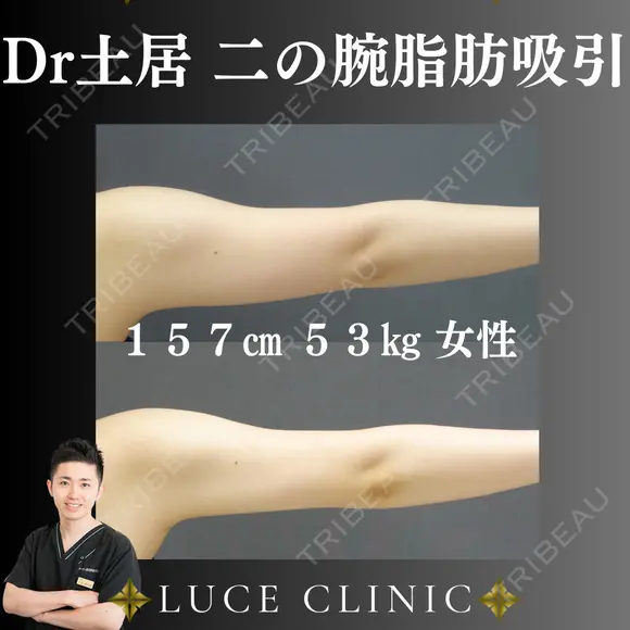 二の腕脂肪吸引 after画像 メイン用