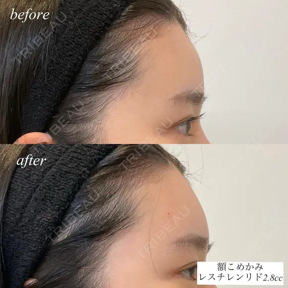 額、こめかみヒアルロン酸注入 after画像 メイン用