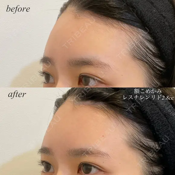 額、こめかみヒアルロン酸注入 after画像 メイン用