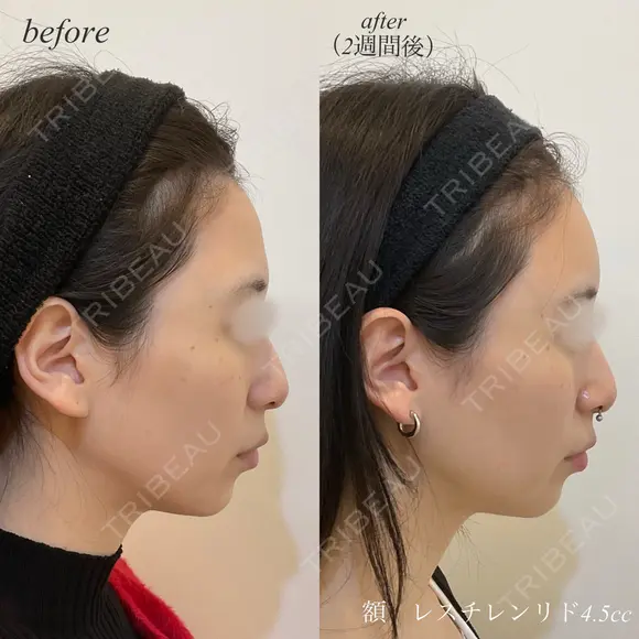 額ヒアルロン酸注入 after画像 メイン用