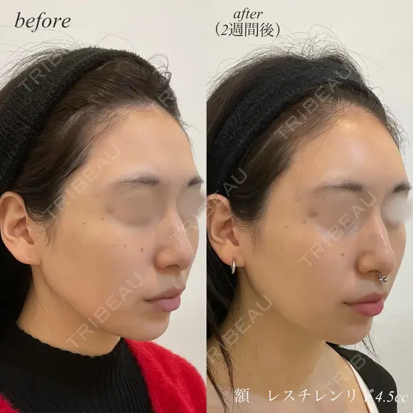 額ヒアルロン酸注入 after画像 メイン用