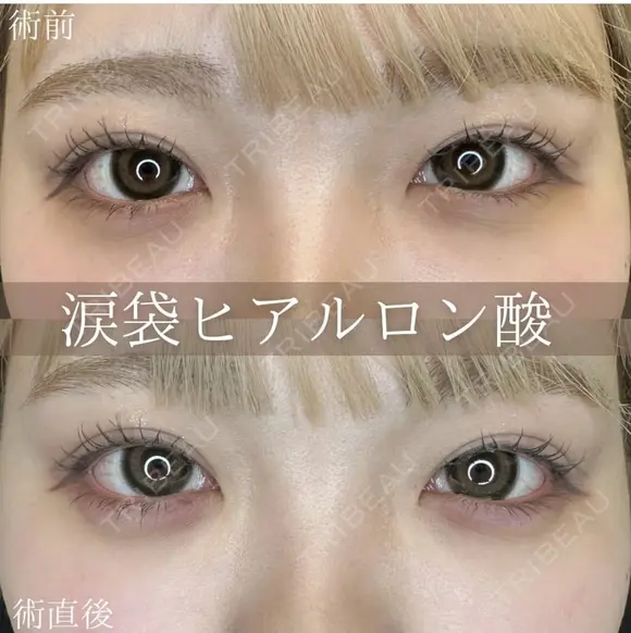 涙袋ヒアルロン酸 before画像 メイン用