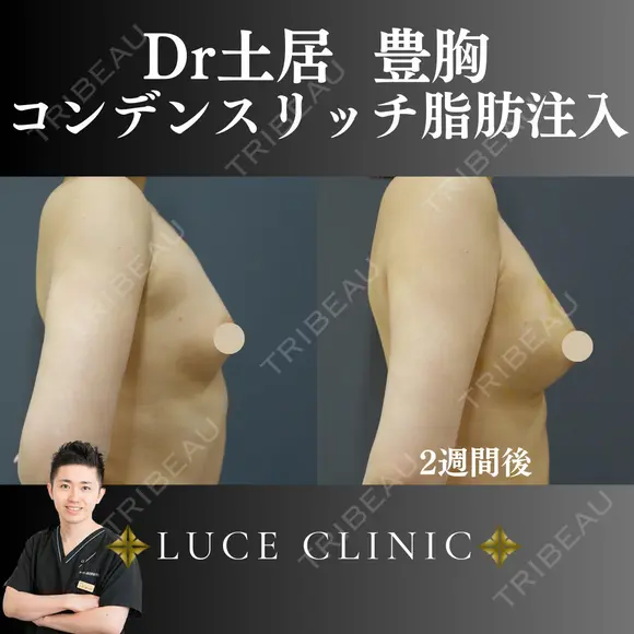コンデンスリッチ脂肪豊胸 before画像 メイン用