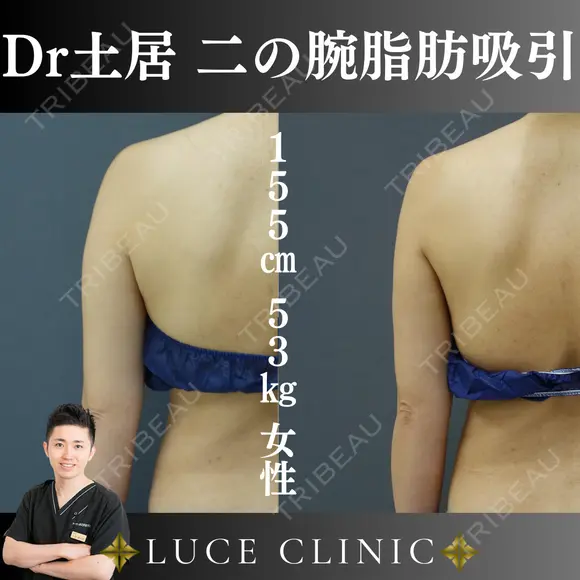 二の腕脂肪吸引 after画像 メイン用