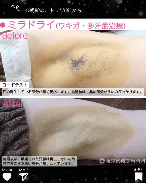 ミラドライ after画像 メイン用