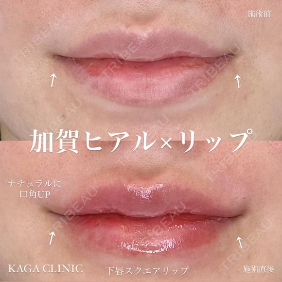加賀ヒアル×リップ before画像 メイン用