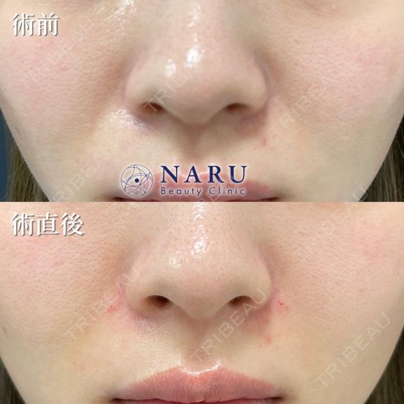 貴族ヒアルロン酸 before画像 メイン用