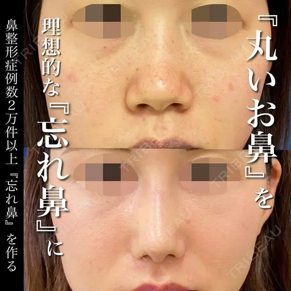 プロテーゼ＋鼻尖形成＋軟骨移植＋鼻柱下降＋鼻翼縮小 before画像 メイン用