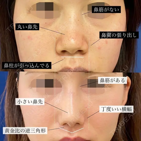 プロテーゼ＋鼻尖形成＋軟骨移植＋鼻柱下降＋鼻翼縮小 after画像 メイン用