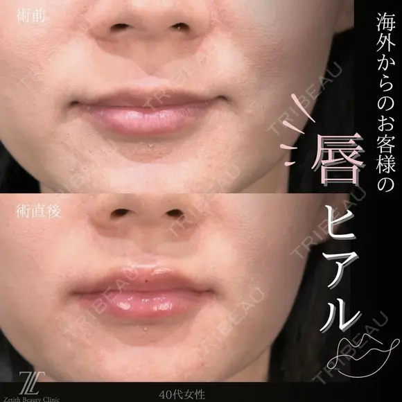 唇ヒアルロン酸 before画像 メイン用