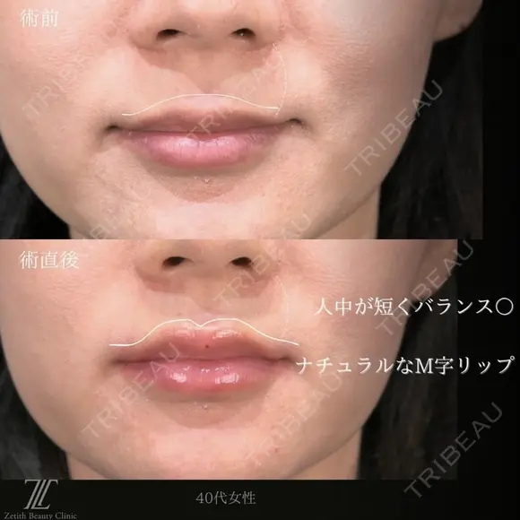 唇ヒアルロン酸 after画像 メイン用