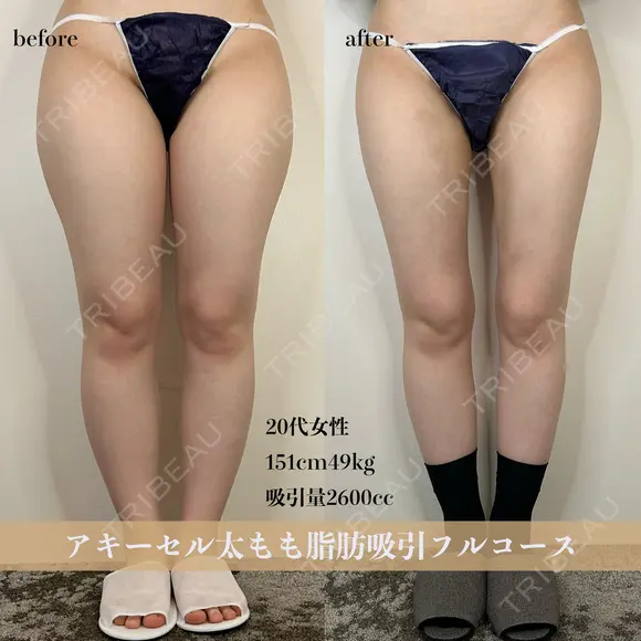 アキーセル太もも脂肪吸引 before画像 メイン用