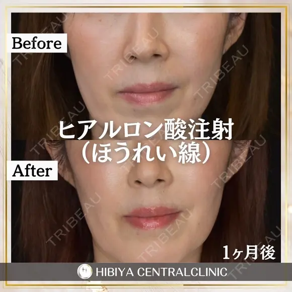 ヒアルロン酸　ほうれい線 before画像 メイン用