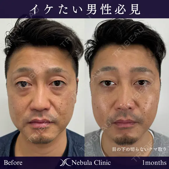 疲れ顔バイバイ👋切らないクマ治療 before画像 メイン用