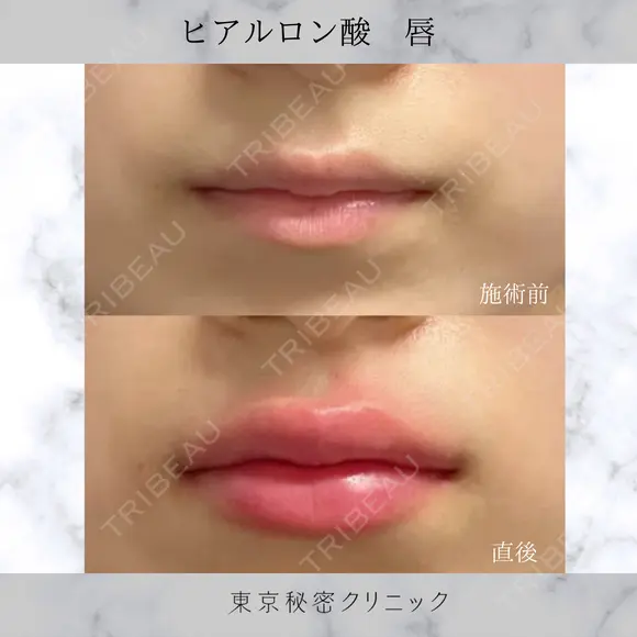 唇ヒアルロン酸 before画像 メイン用