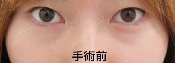 埋没法（週末二重術） before画像 メイン用