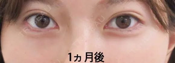 埋没法（週末二重術） 31日後 メイン用