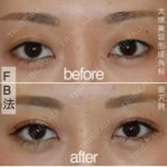 目元の印象アップ💞二重埋没 before画像 メイン用