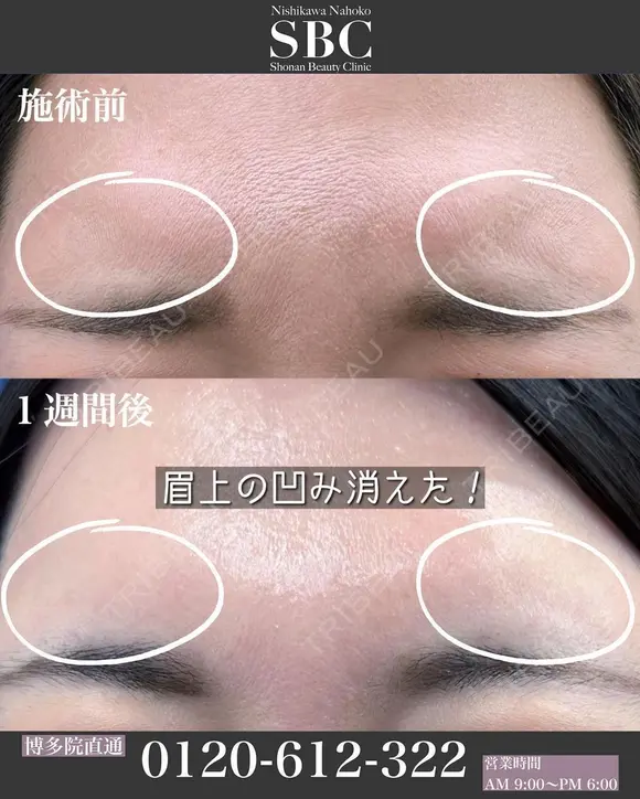ボトックス注射(眉間) after画像 メイン用