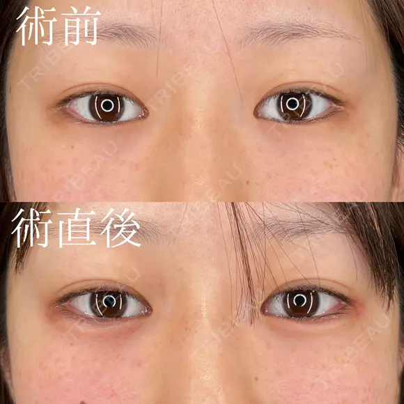 ヒアルロン酸注入（涙袋） after画像 メイン用
