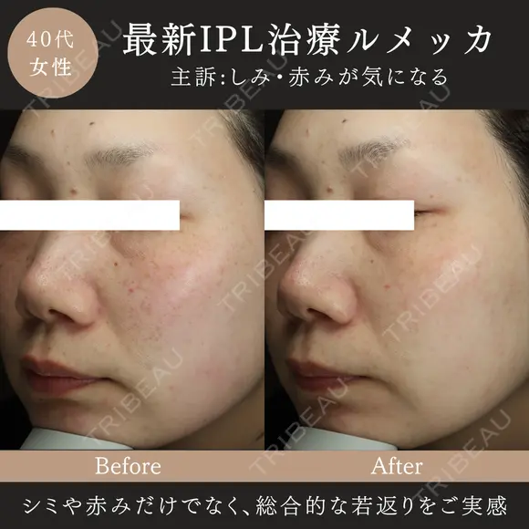 ルメッカ(IPL治療) before画像 メイン用