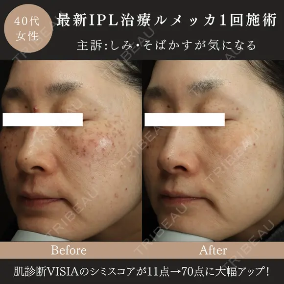 ルメッカ(IPL治療) after画像 メイン用