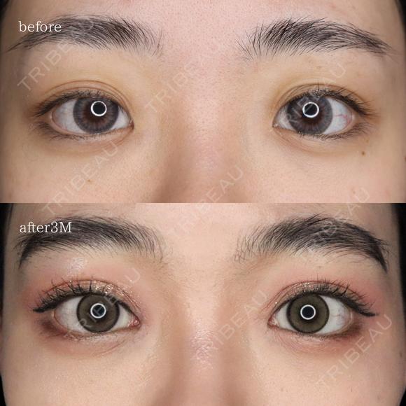 目頭切開 90日後 メイン用
