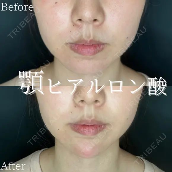 顎ヒアルロン酸 before画像 メイン用