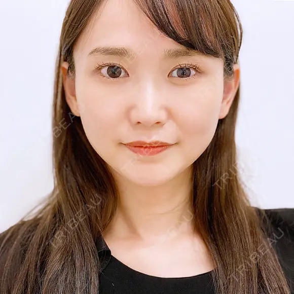 【メスを使わない小顔術】 長年のお悩みを即日解消します！小顔Aスレッド®処置前と処置直後の症例です【小顔Aスレッド®】 before画像 メイン用