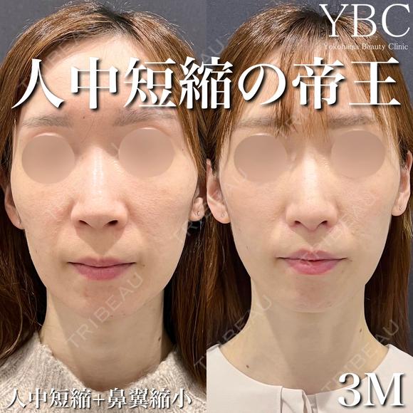 【🐣人中短縮🐣】 after画像 メイン用