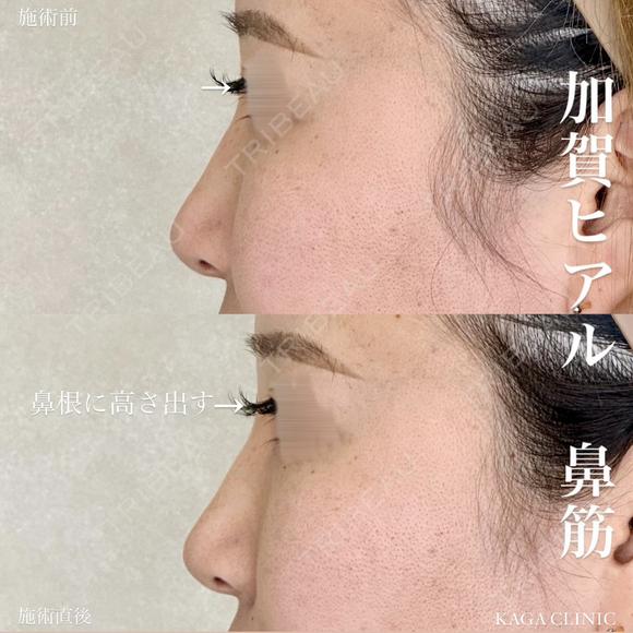 加賀ヒアル×鼻筋 after画像 メイン用