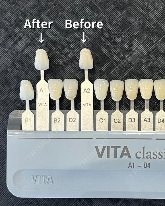 ホワイトニング🦷✨ after画像 メイン用