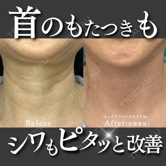 【首のしわ・たるみ解消】ネックリフト×ボライト2cc 1日後 メイン用