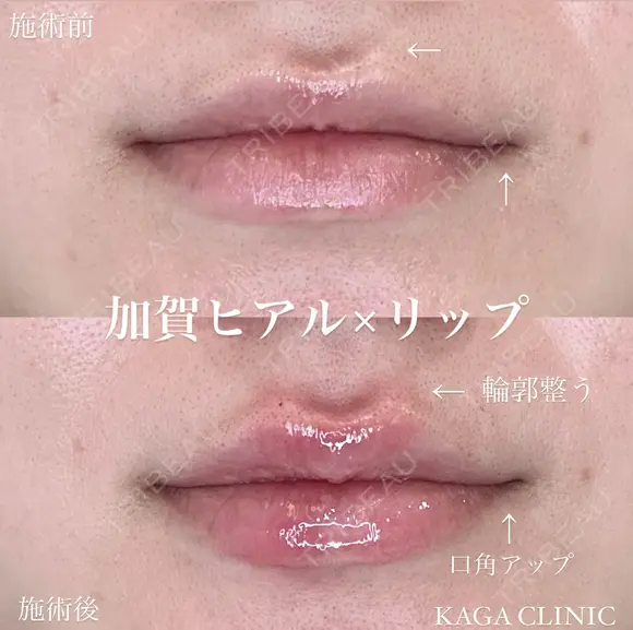 加賀ヒアル×リップ before画像 メイン用