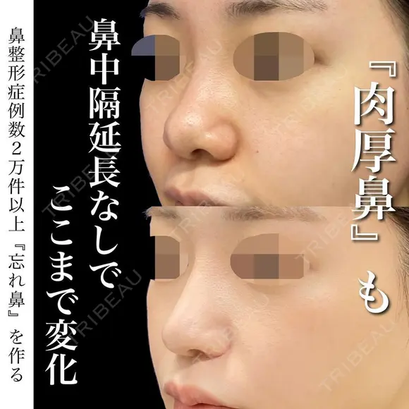 プロテーゼ、鼻尖形成、鼻尖部軟骨移植、鼻翼縮小、肉厚減幅 after画像 メイン用