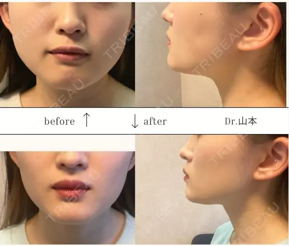 エラボトックス before画像 メイン用