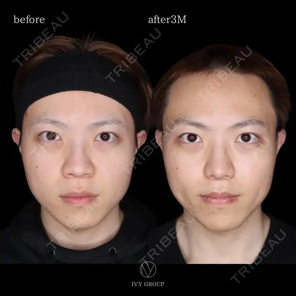 小鼻縮小＋鼻尖形成オープン法＋耳介軟骨移植 before画像 メイン用