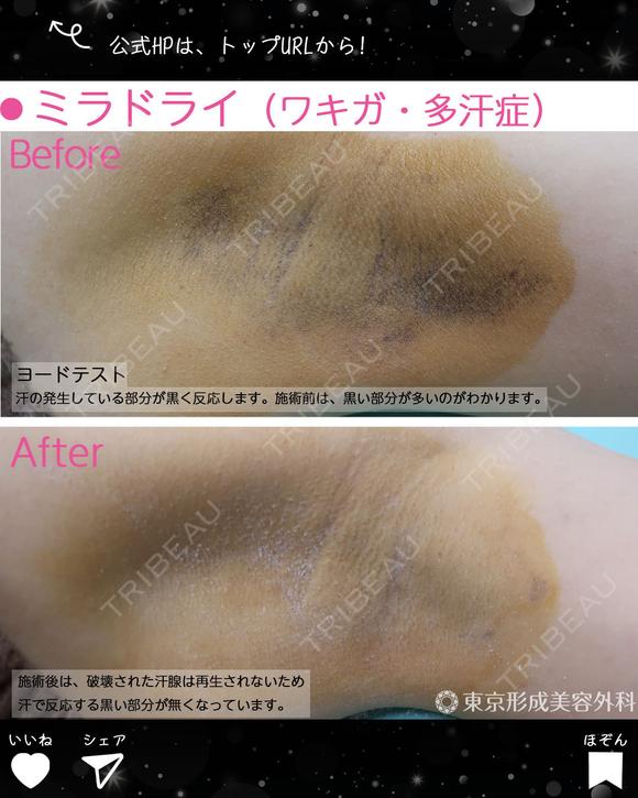 ミラドライ（ワキガ・多汗症） after画像 メイン用