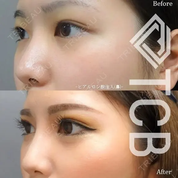 高くキレイな鼻筋へ🌹ヒアルロン酸注入💉 before画像 メイン用