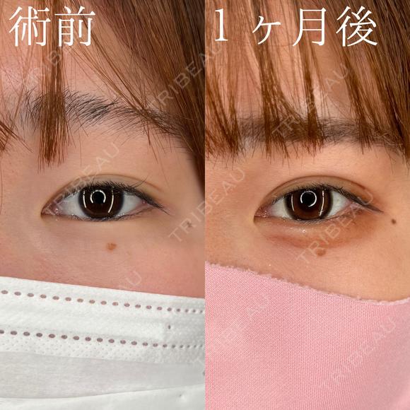二重埋没法/ヒアルロン酸注入（涙袋） 30日後 メイン用
