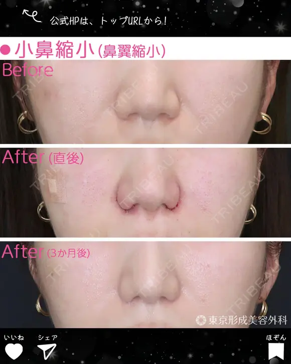 小鼻縮小（鼻翼縮小） after画像 メイン用