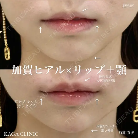加賀ヒアル×リップ＋顎 after画像 メイン用