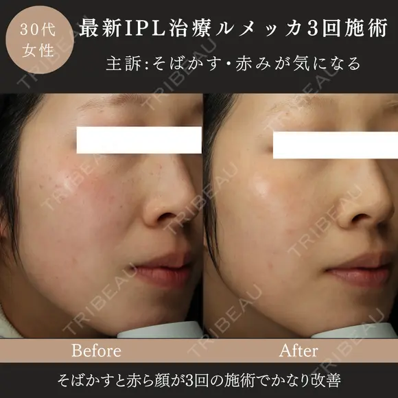 ルメッカ(IPL治療) after画像 メイン用